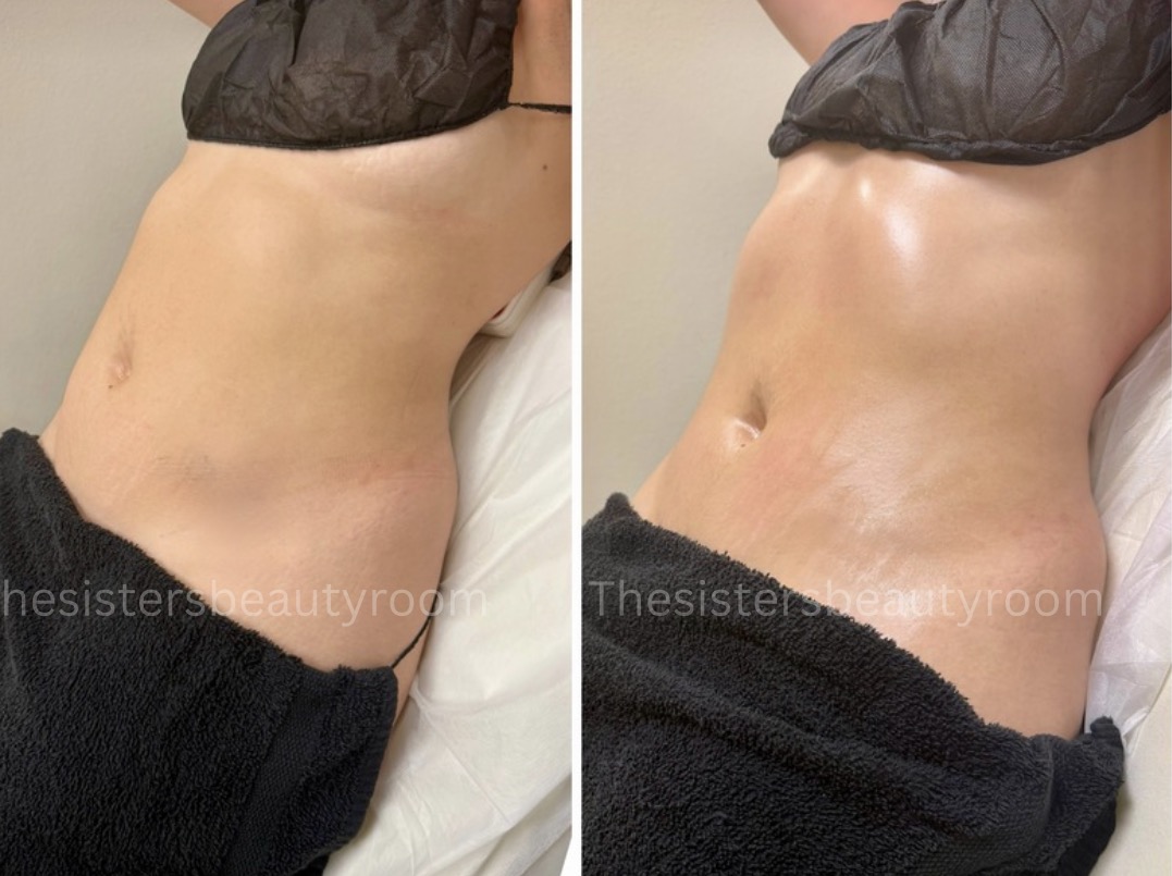 Before and after client result 2