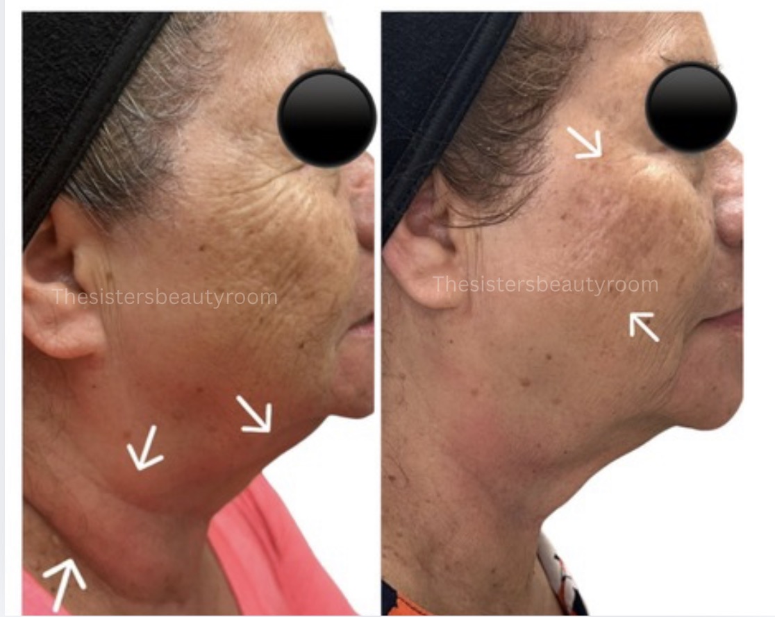 Before and after client result 4